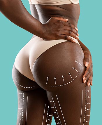 Brazilian Butt Lift in Chicago, IL
