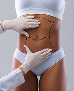Cellulite Treatment by Aveli in Chicago, IL