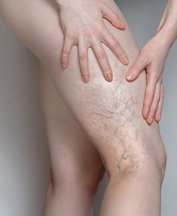Spider Veins (Sclerotherapy) in Chicago, IL 
