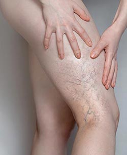 Spider Veins (Sclerotherapy) in Chicago, IL 
