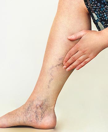 Varicose Veins (Phlebotomy) in Chicago, IL
