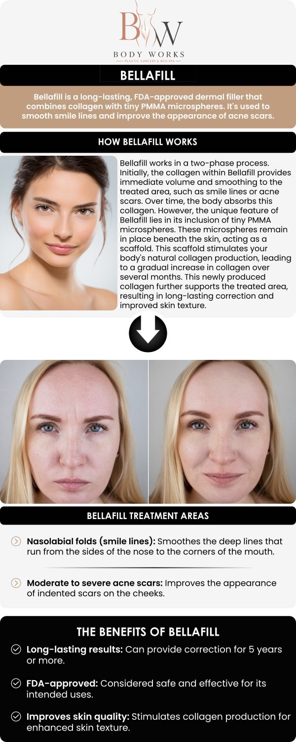 Common questions asked by patients: What is Bellafill? What does Bellafill treat? How long do the Bellafill results last? Am I a good candidate for Bellafill at Body Works Plastic Surgery? For more information, contact us or request an appointment online. We are conveniently located at 3918 W 63rd St, Chicago, IL 60629.