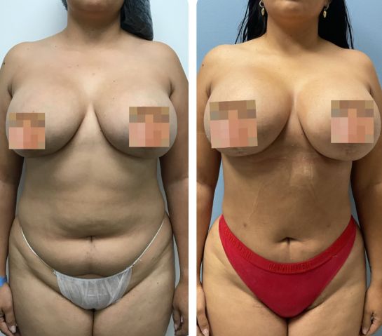 Before and After Body Liposuction at Body Works Plastic Surgery in Chicago, IL
