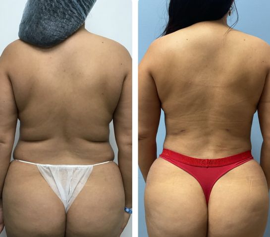 Before and After Body Liposuction at Body Works Plastic Surgery in Chicago, IL