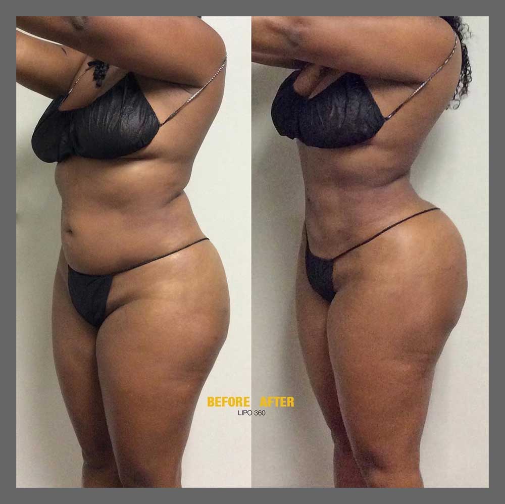 Before and After Body Liposuction at Body Works Plastic Surgery in Chicago, IL