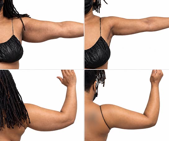 Arms Before & After Treatment Results at Body Works Plastic Surgery in Chicago, IL