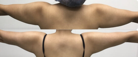 Arms Before & After Treatment Results at Body Works Plastic Surgery in Chicago, IL