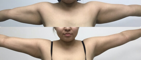 Arms Before & After Treatment Results at Body Works Plastic Surgery in Chicago, IL