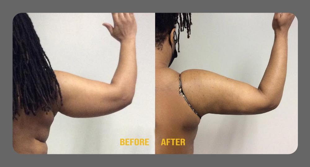 Arms Before & After Treatment Results at Body Works Plastic Surgery in Chicago, IL