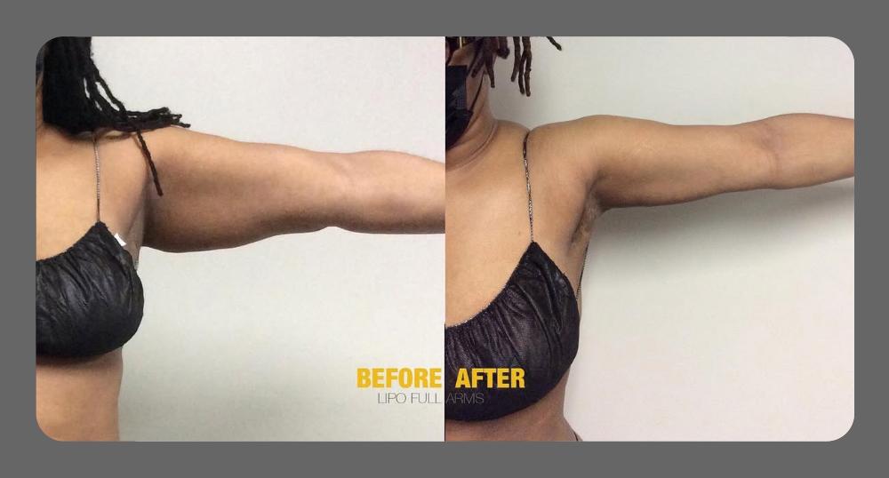 Arms Before & After Treatment Results at Body Works Plastic Surgery in Chicago, IL