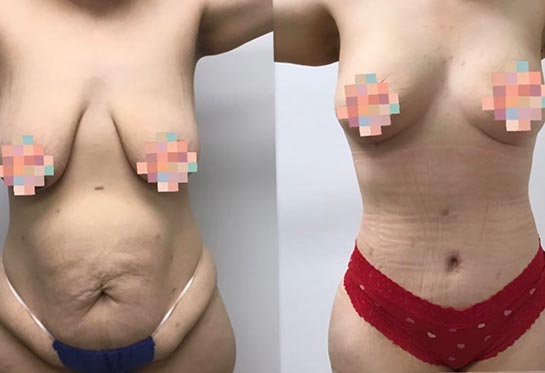 Before and After Tummy Tuck at Body Works Plastic Surgery in Chicago, IL
