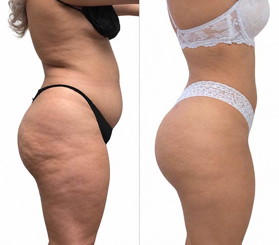 Before and After Body Liposuction at Body Works Plastic Surgery in Chicago, IL