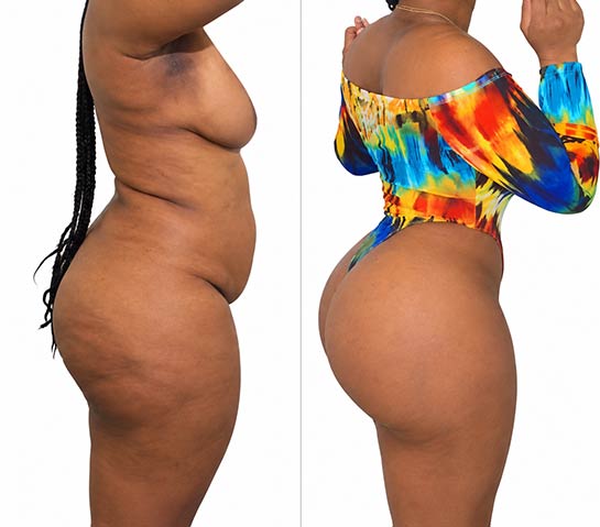 Before and After Body Liposuction at Body Works Plastic Surgery in Chicago, IL