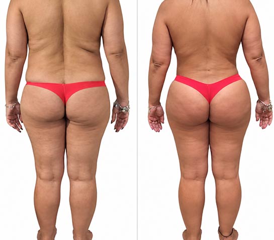Before and After Body Liposuction at Body Works Plastic Surgery in Chicago, IL