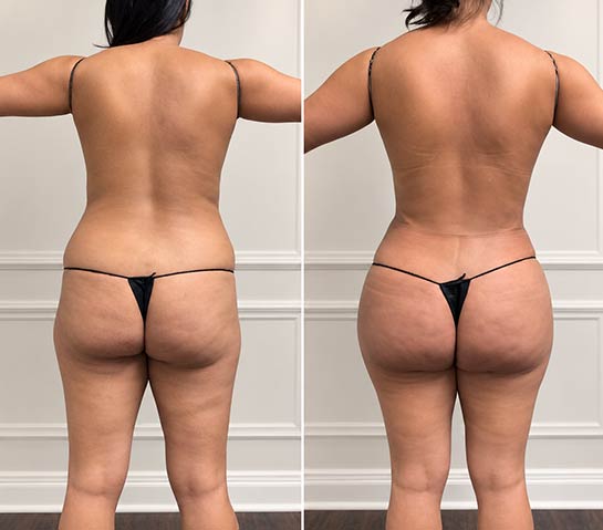 Before and After Body Liposuction at Body Works Plastic Surgery in Chicago, IL