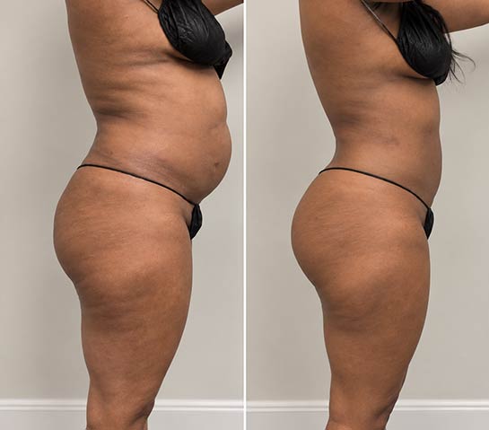 Before and After Body Liposuction at Body Works Plastic Surgery in Chicago, IL