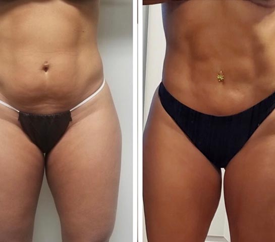 Before and After Body Liposuction at Body Works Plastic Surgery in Chicago, IL