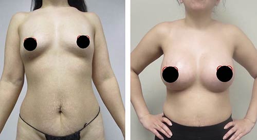 Breast Augmentation Lift Before & After Treatment Results at Body Works Plastic Surgery in Chicago, IL
