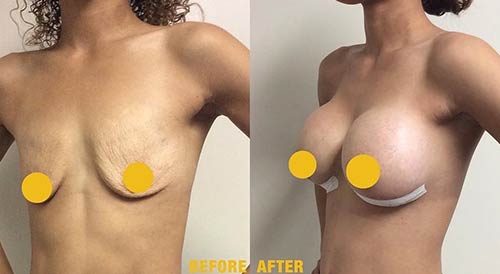 Breast Augmentation Lift Before & After Treatment Results at Body Works Plastic Surgery in Chicago, IL