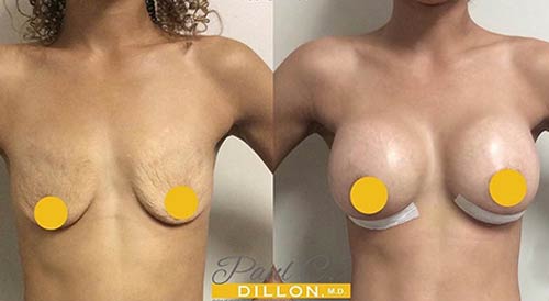 Breast Augmentation Lift Before & After Treatment Results at Body Works Plastic Surgery in Chicago, IL