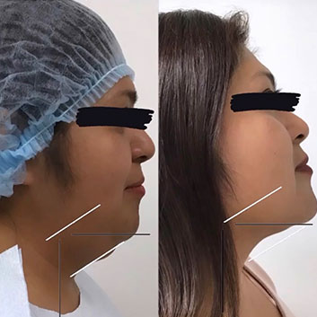 Before and After HD LipoX® of Jawline at Body Works Plastic Surgery in Chicago, IL