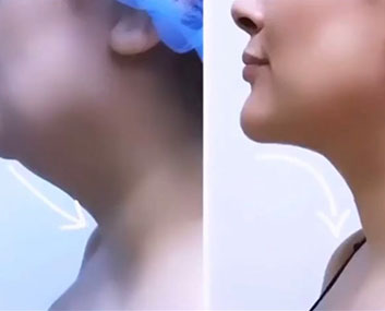 Before and After HD LipoX® of Jawline at Body Works Plastic Surgery in Chicago, IL