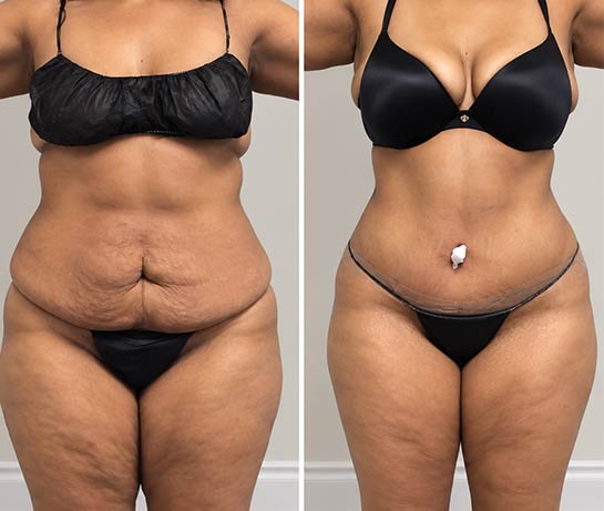 Before and After Tummy Tuck at Body Works Plastic Surgery in Chicago, IL